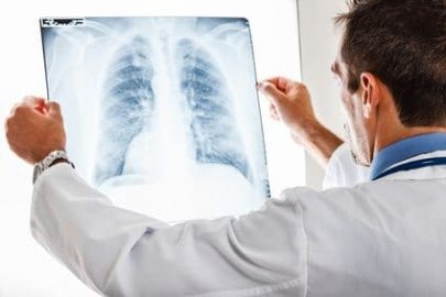 Bronchopneumopathie chronique obstructive - Hypertension pulmonaire