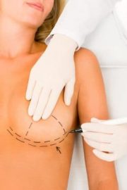 Chirurgie plastique - Mastopexie