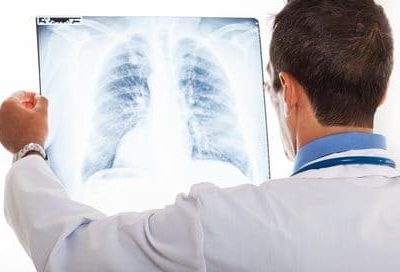 Champignons dangereux pour les poumons ? Par Dr Nicolas Benoît, pneumologue