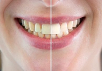 Blanchiment des dents - Dentisterie