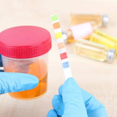 Comment éviter les cristaux d'urate de sodium ? Par le Docteur Mathieu Kuentz