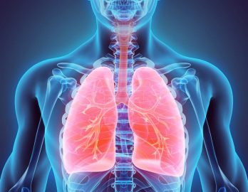 Fibrose pulmonaire idiopatique - Fibrose pulmonaire